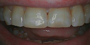 Postop anterior photo after treatment at Durham DDS.