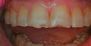 Preop anterior photo before treatment at Durham DDS.