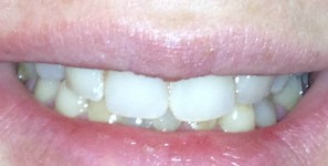 Postop anterior photo after treatment at Durham DDS.
