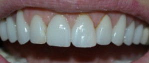 Postop anterior photo after fractured veneer treatment at Durham DDS.