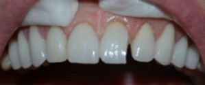 Preop anterior photo before fractured veneer treatment at Durham DDS.