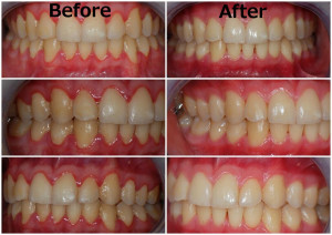 In the before images, the gums look red and swollen. In the after images, the gums are healthy, pink, and firm.