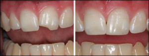 A before and after view of a repaired tooth chip. 