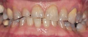 heavy-tooth-wear-treated-with-emax-porcelain-crowns-dental-rehabilitation-inside-mouth-before